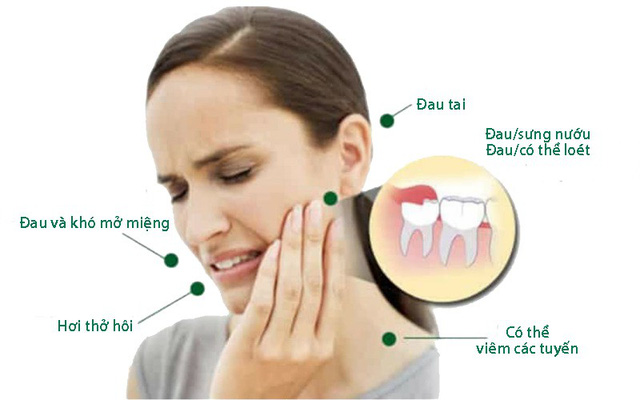 Nhổ răng khôn - Nha khoa Codofa Dental uy tín chất lượng